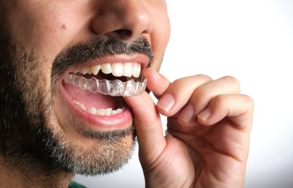 Important Things To Know Before Clear Aligners Teeth Straightening
